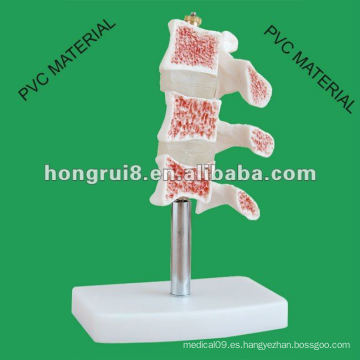 Lesiones típicas del modelo de la columna vertebral ------- Cutaway Osteoporosis